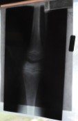 An X-ray of our son's leg assuring us that it was not broken!